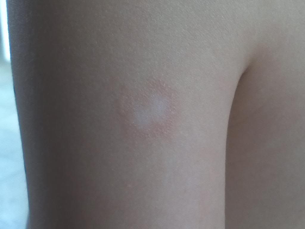 De quoi apparaît le psoriasis de la photo le stade initial